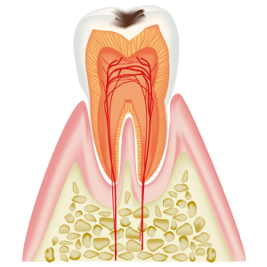 C1　エナメル質内の虫歯