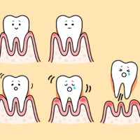 歯周病の進行