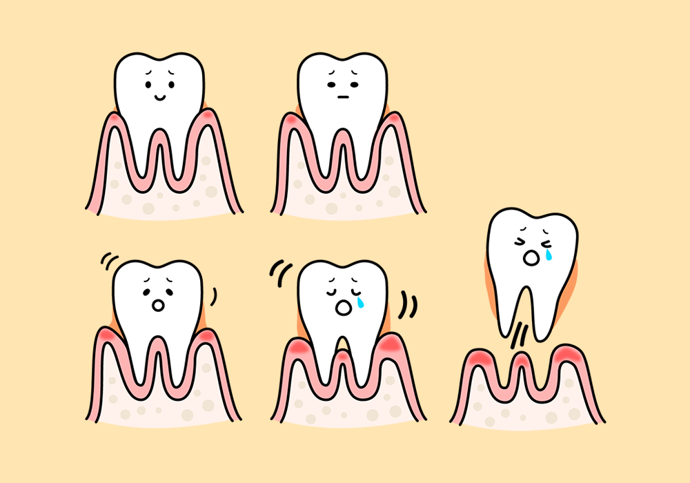 歯周病の進行