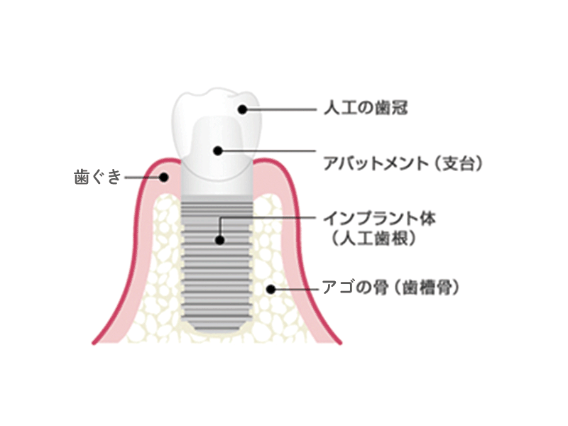 インプラントの構造