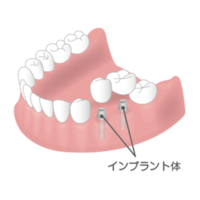 インプラント