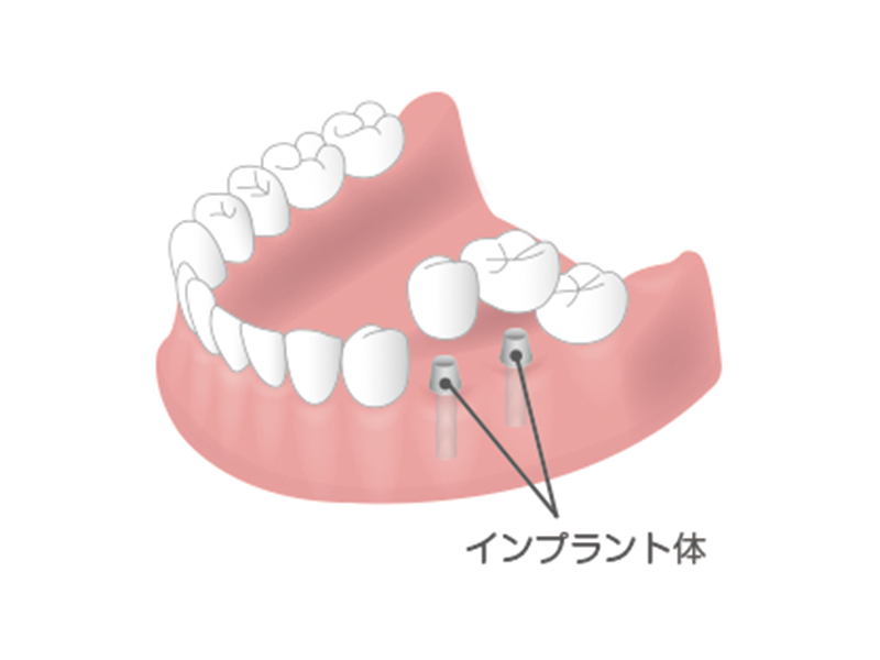 インプラント