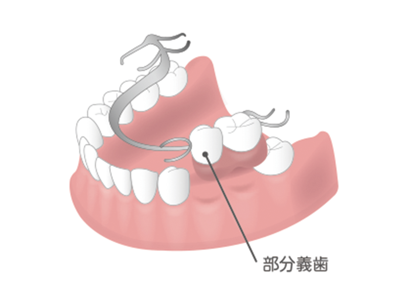 部分入れ歯