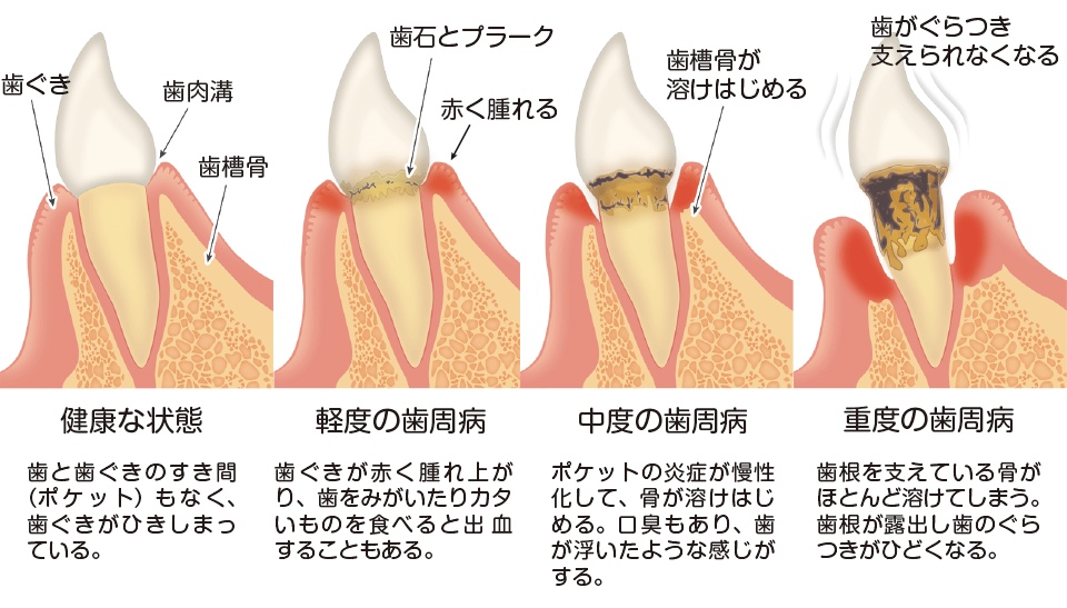 歯周病の進行