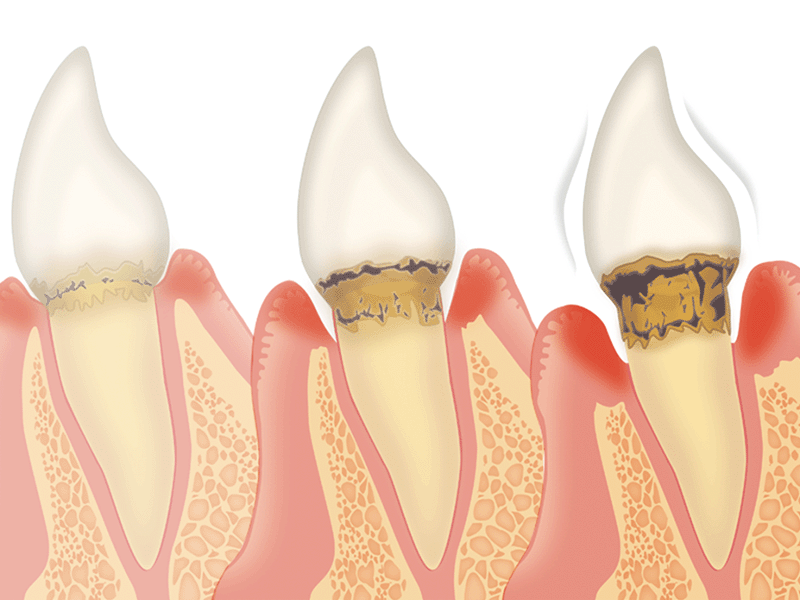 歯周病の過程