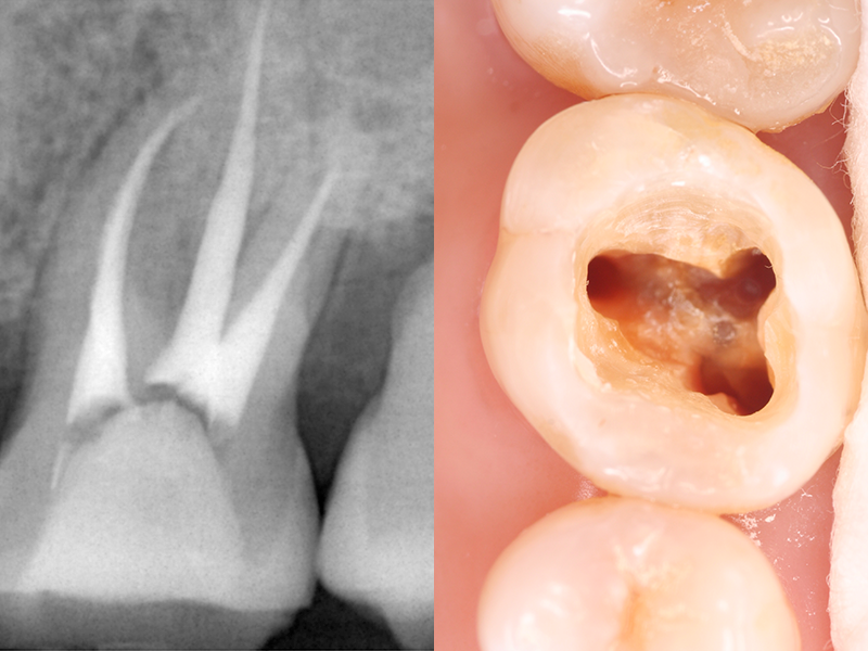 根管治療のようす