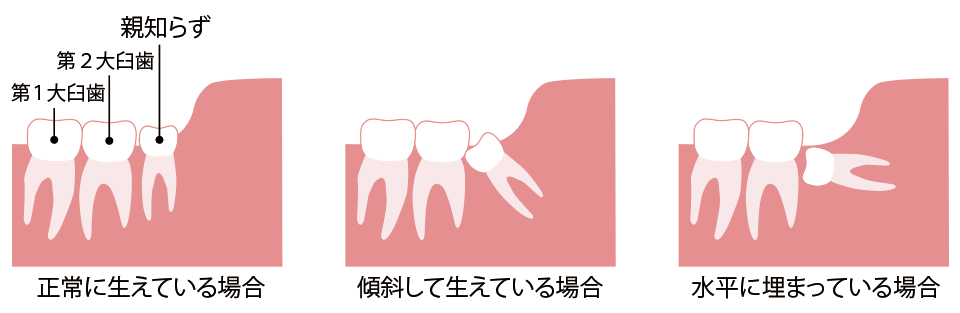 親知らずの様子